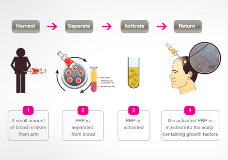 PRP Additional Image at Cosmocare Medical Center